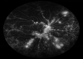 Imaging-Based Uveitis Surveillance Feasible for Patients With Juvenile Idiopathic Arthritis